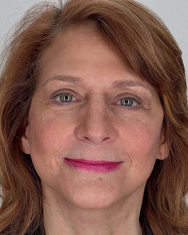 Blepharoplasty Before & After