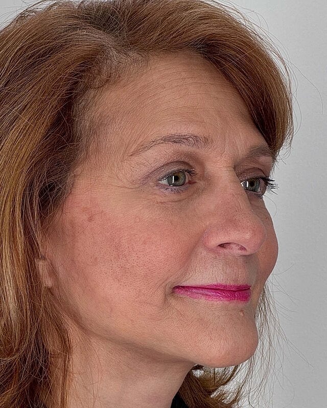 Blepharoplasty Before & After