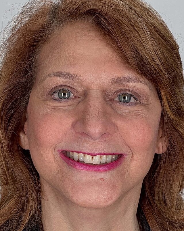 Blepharoplasty Before & After