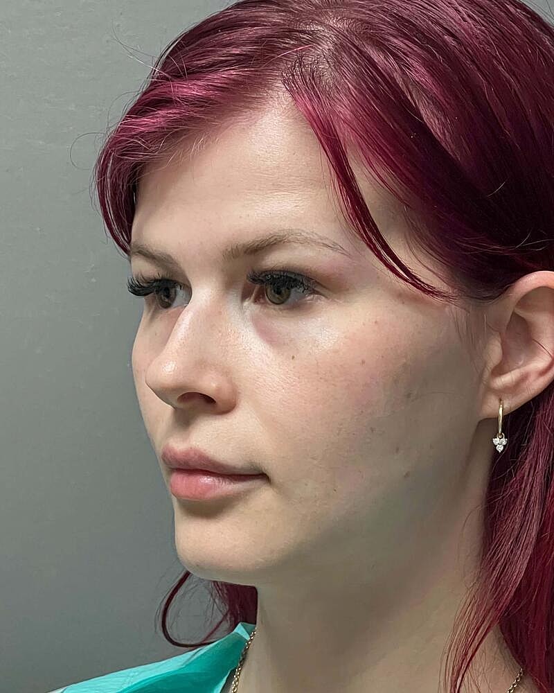 Blepharoplasty Before & After
