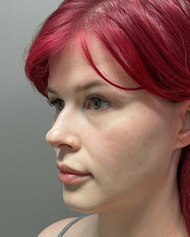 Blepharoplasty Before & After