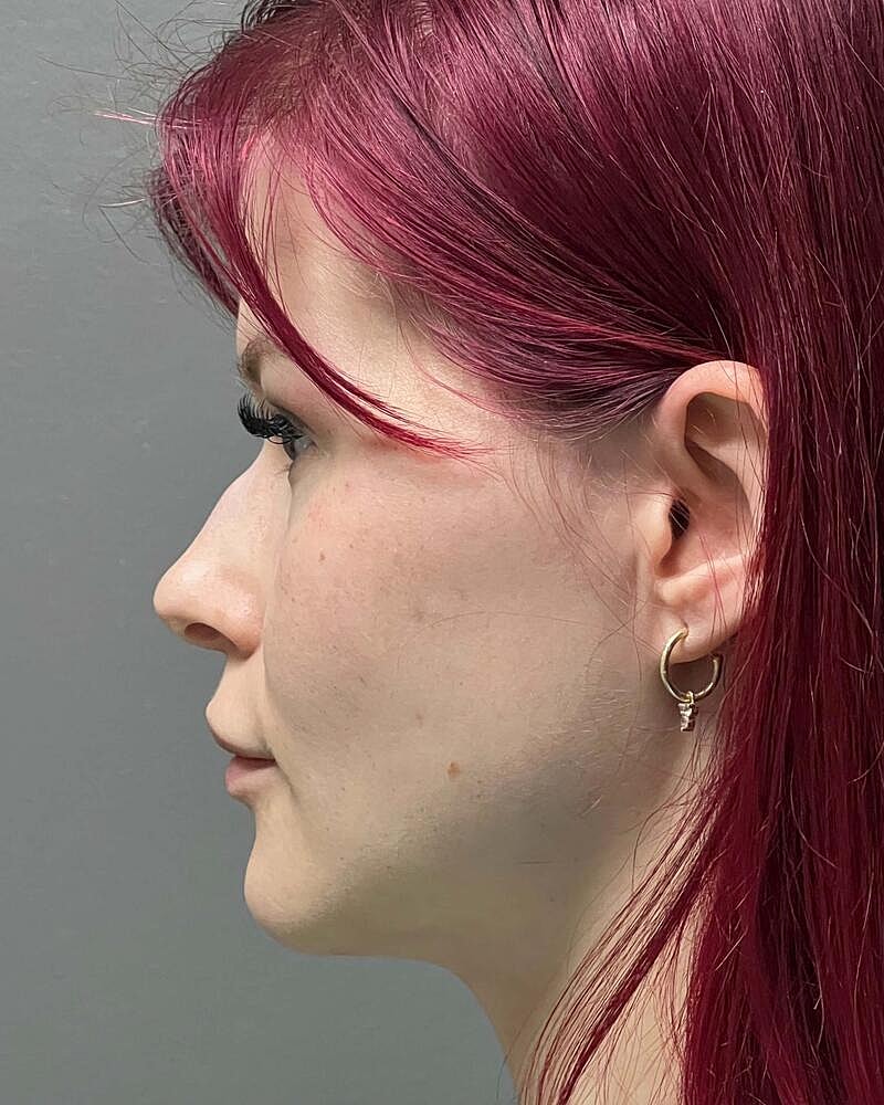 Blepharoplasty Before & After