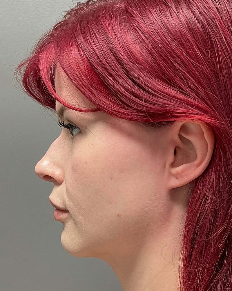Blepharoplasty Before & After
