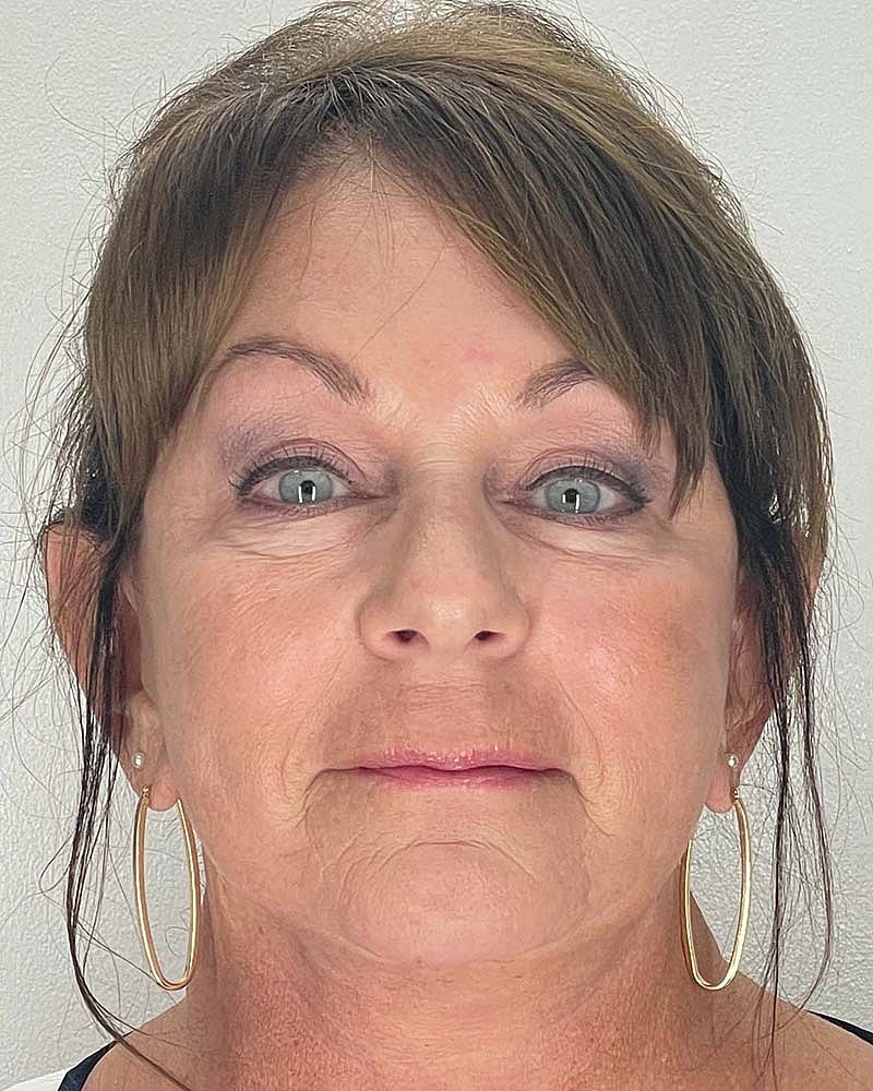 Blepharoplasty Before & After