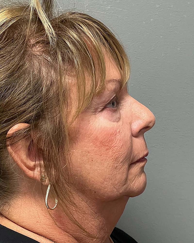 Blepharoplasty Before & After