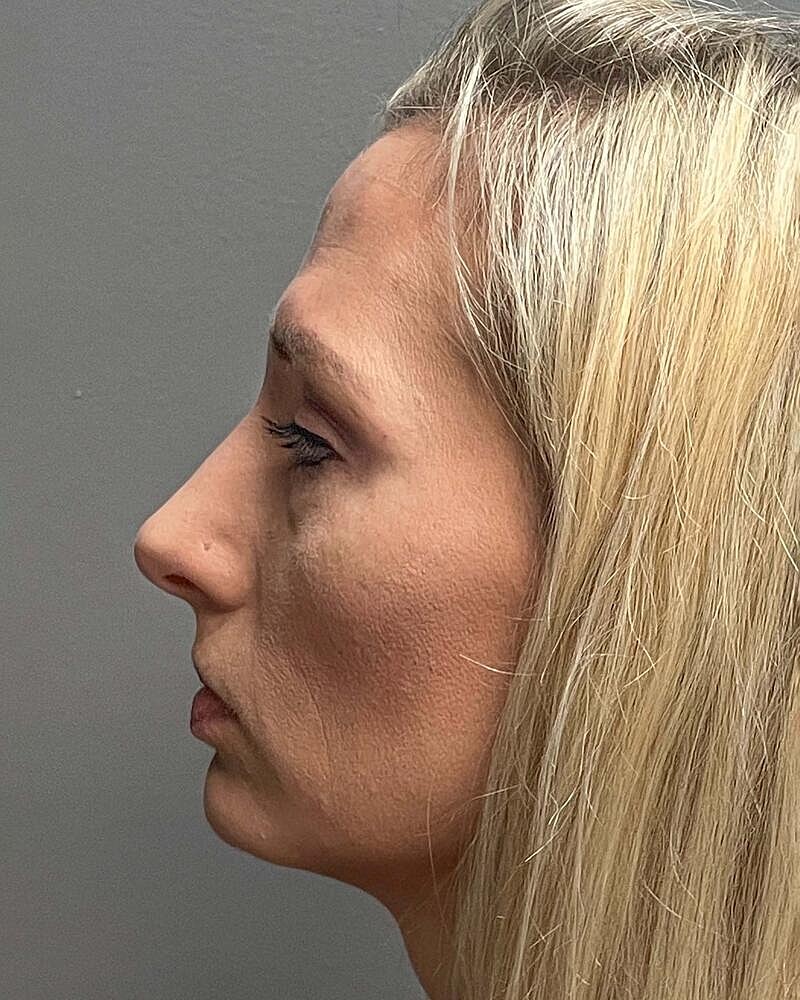 Blepharoplasty Before & After
