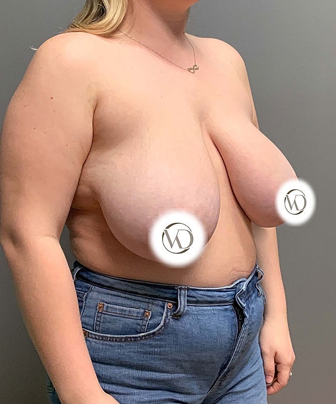 Breast Reduction Before & After