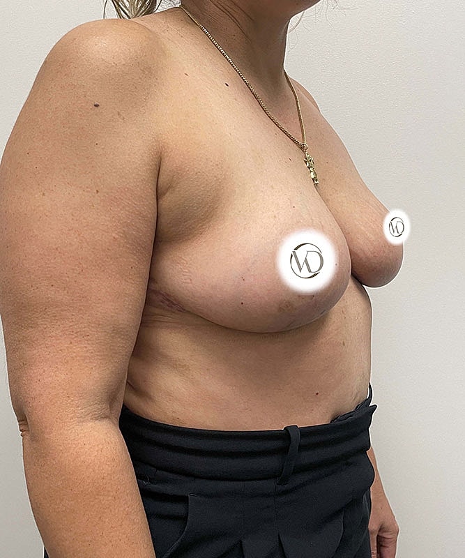 Breast Reduction Before & After