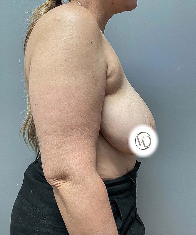 Breast Reduction Before & After