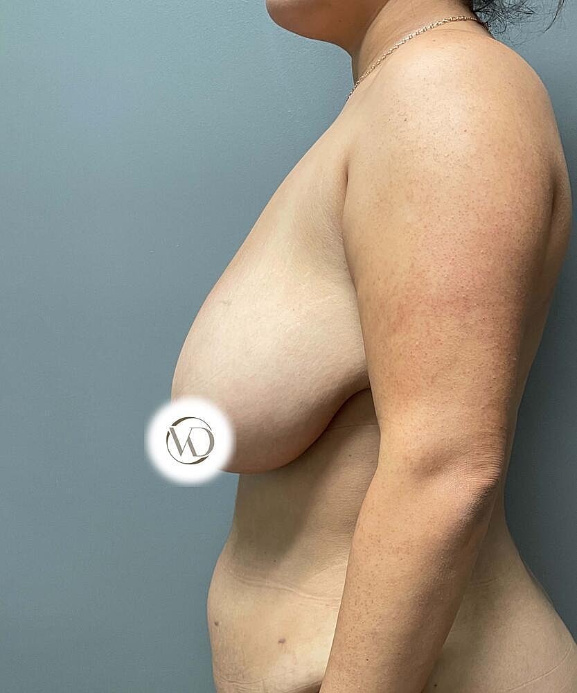 Breast Reduction Before & After