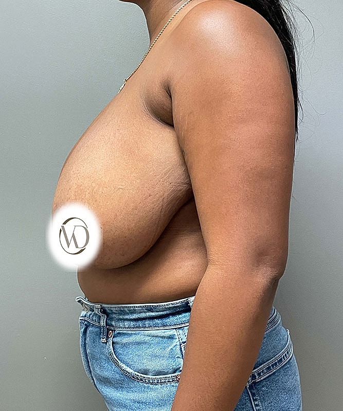 Breast Reduction Before & After