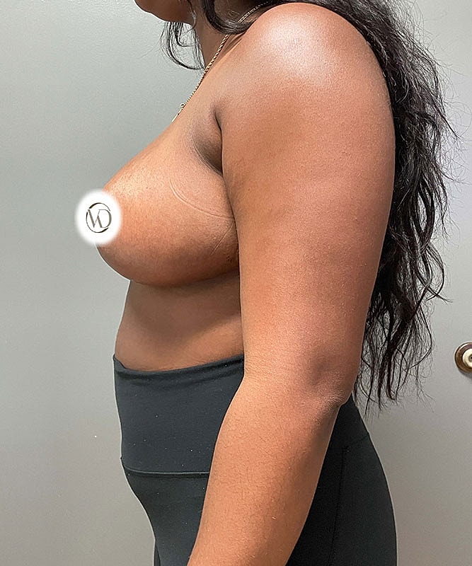Breast Reduction Before & After
