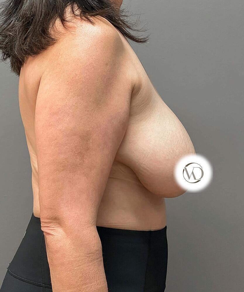 Breast Reduction Before & After