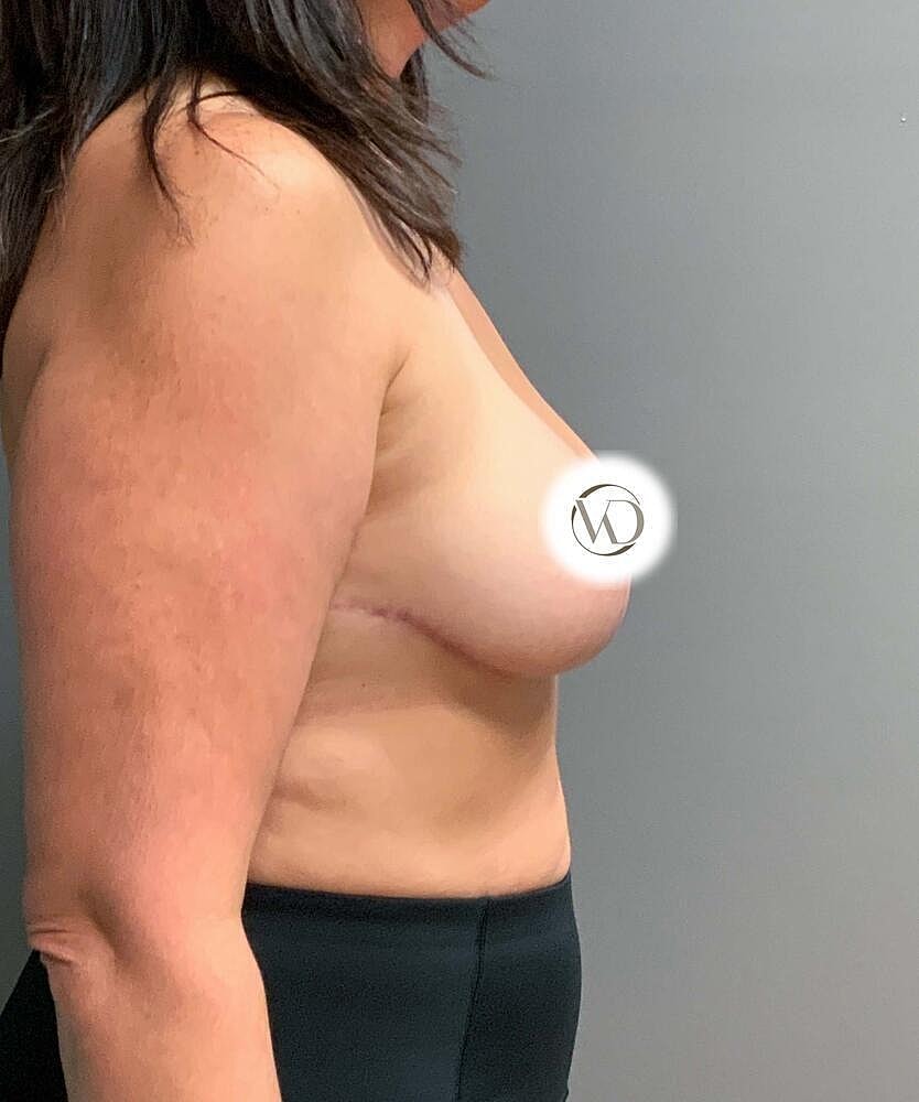 Breast Reduction Before & After