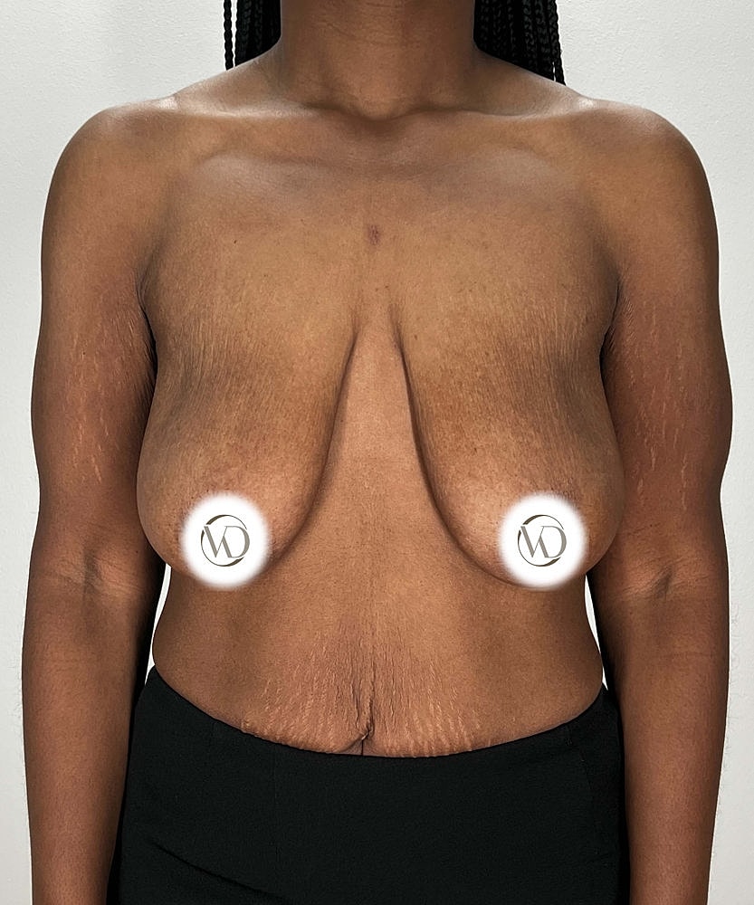 Breast Reduction Before & After