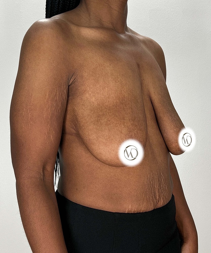 Breast Reduction Before & After
