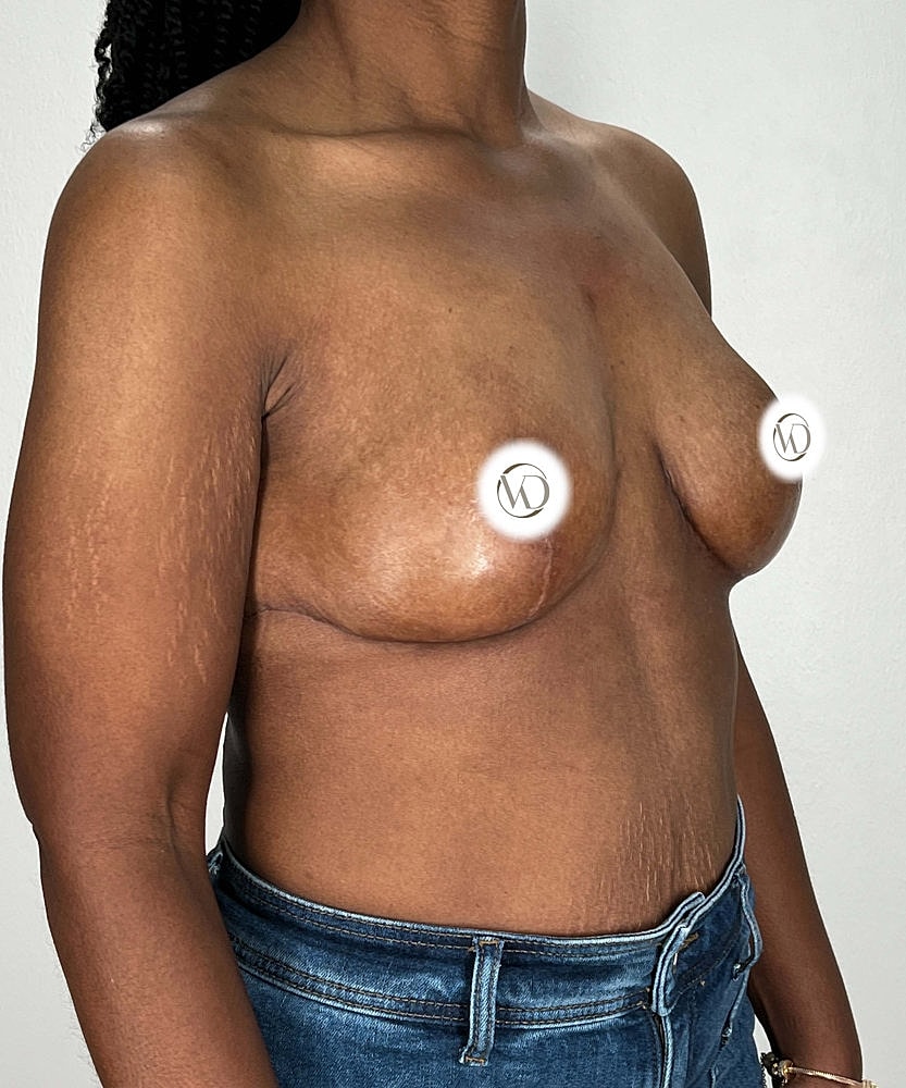 Breast Reduction Before & After