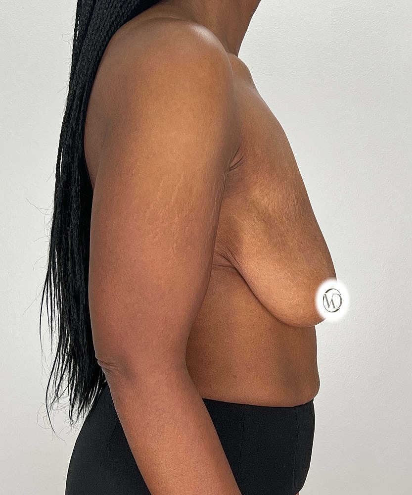 Breast Reduction Before & After
