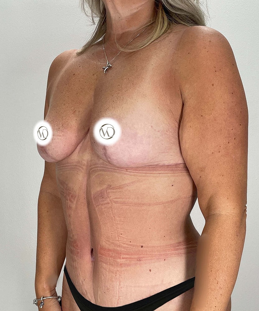 Breast Reduction Before & After