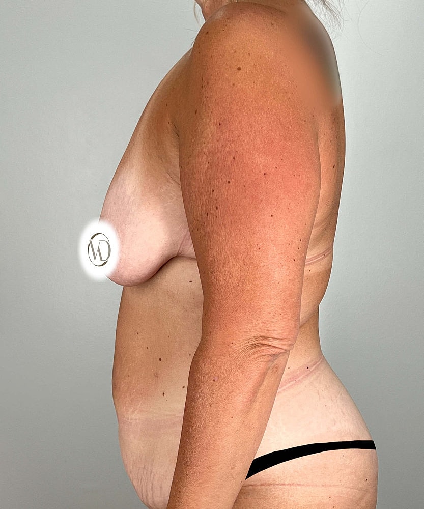 Breast Reduction Before & After