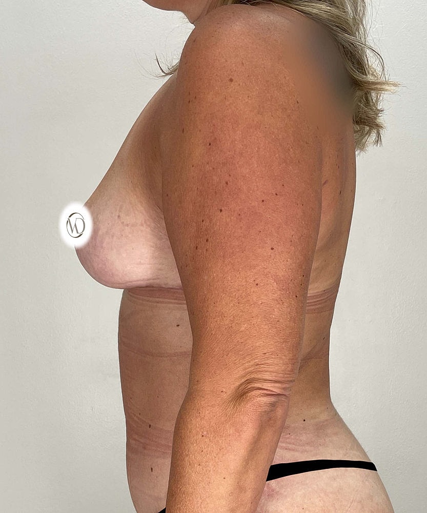 Breast Reduction Before & After