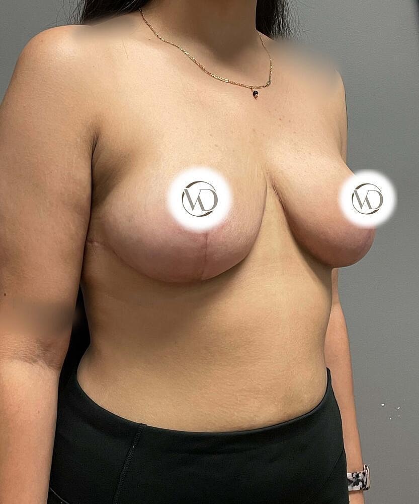 Breast Reduction Before & After