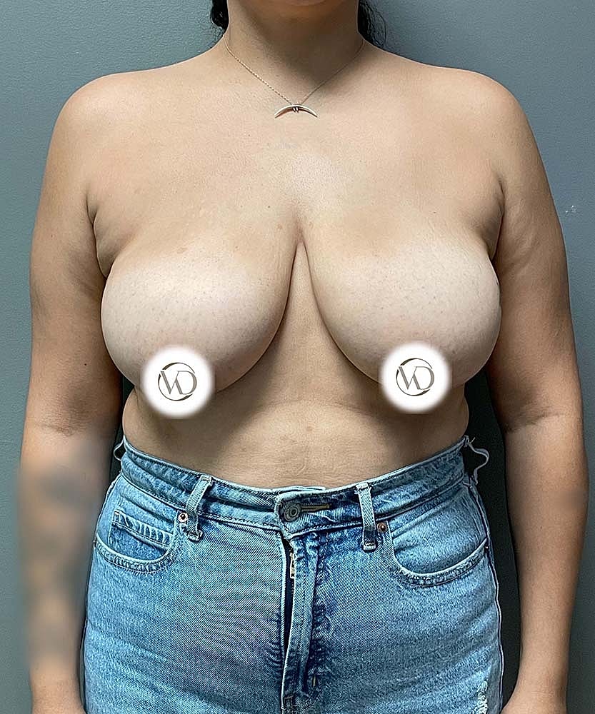 Breast Reduction Before & After