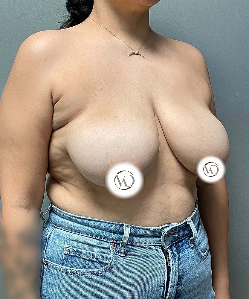 Breast Reduction Before & After