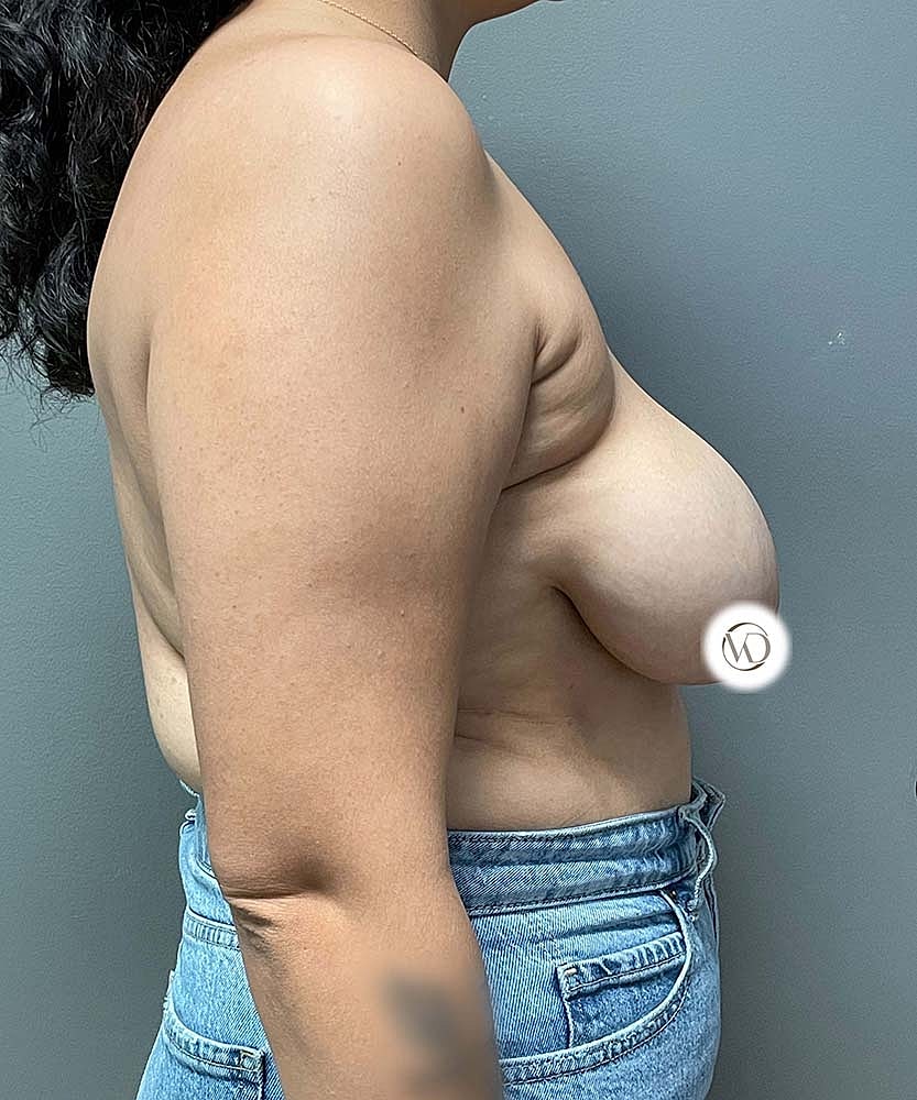 Breast Reduction Before & After