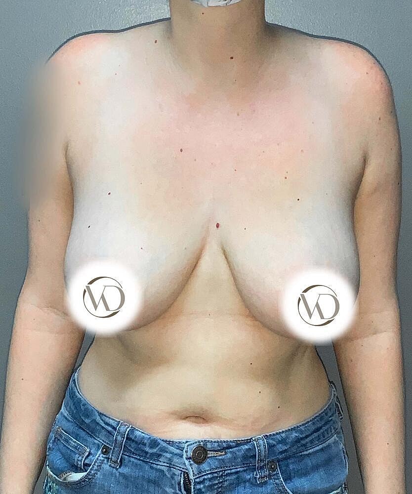 Breast Reduction Before & After