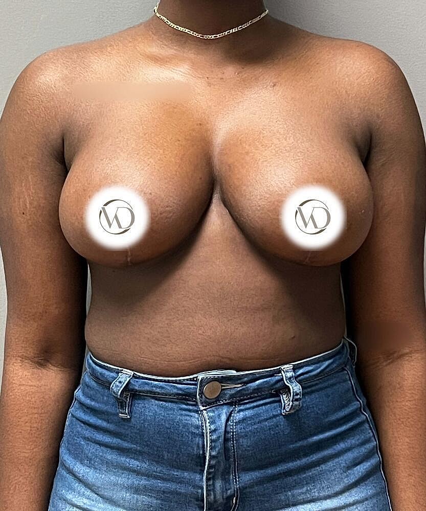 Breast Reduction Before & After