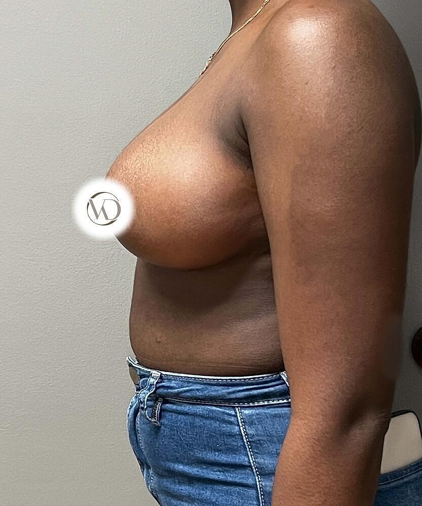 Breast Reduction Before & After