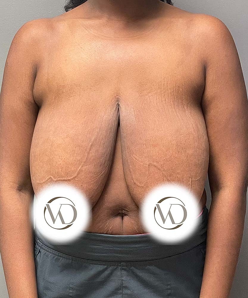 Breast Reduction Before & After