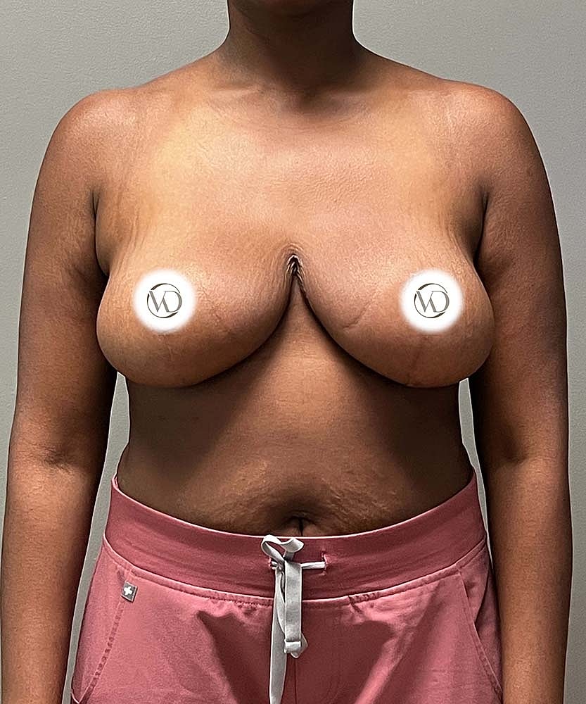 Breast Reduction Before & After