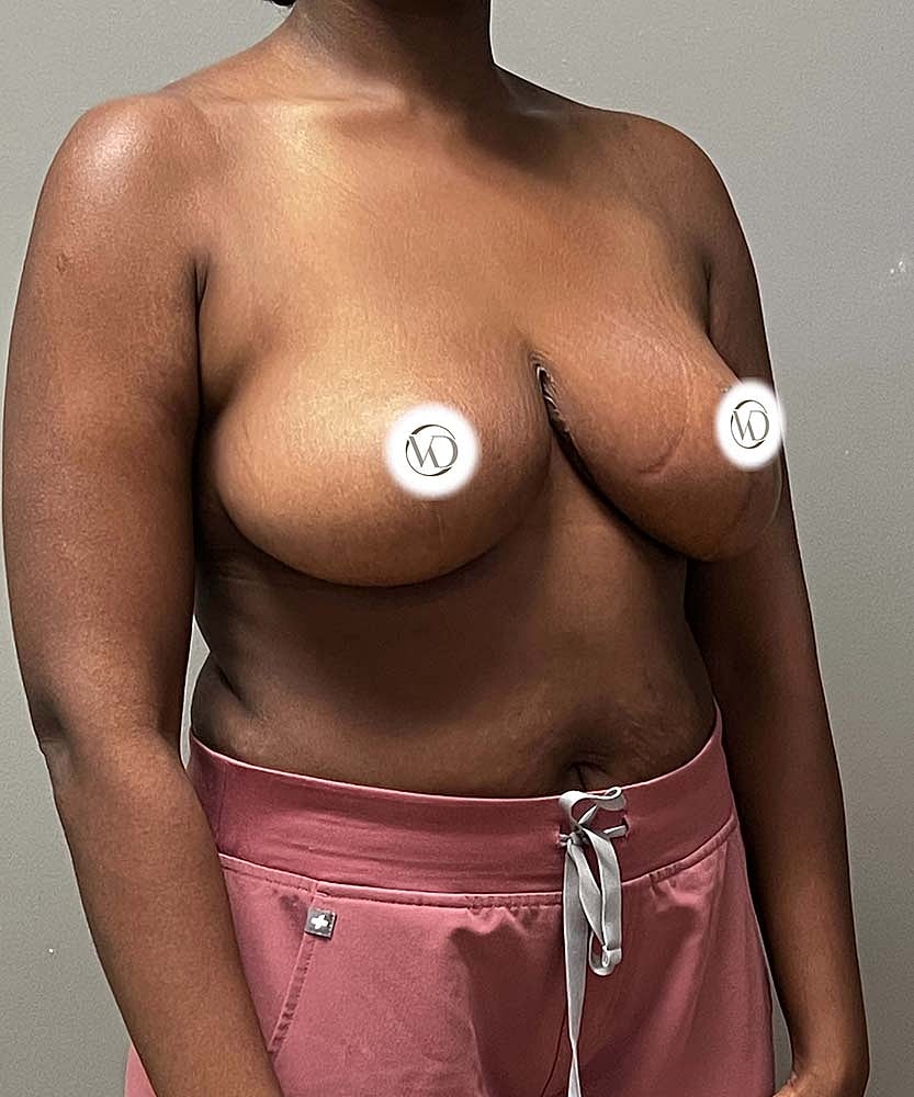 Breast Reduction Before & After