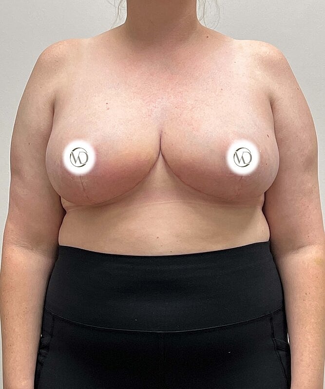 Breast Reduction Before & After