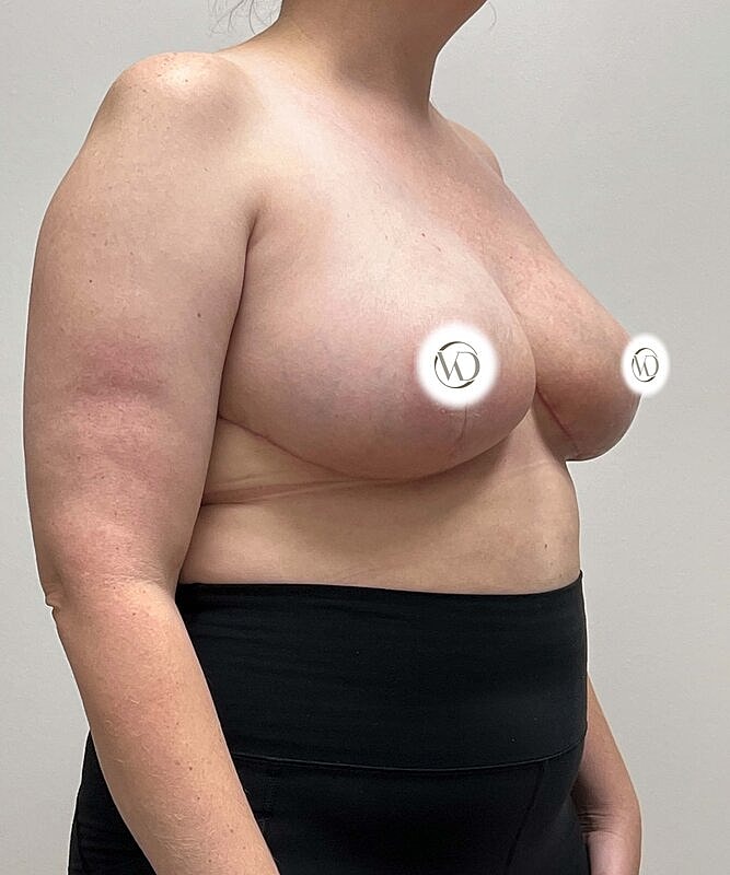 Breast Reduction Before & After