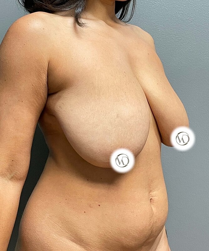 Breast Reduction Before & After