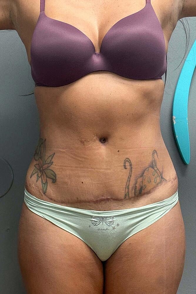 Scar Revision Before & After