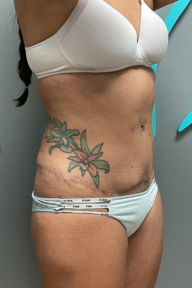 Scar Revision Before & After