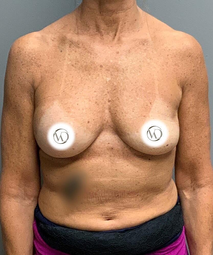 Breast Implant Exchange Before & After