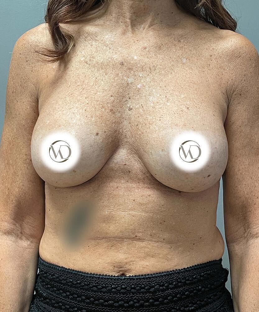 Breast Implant Exchange Before & After