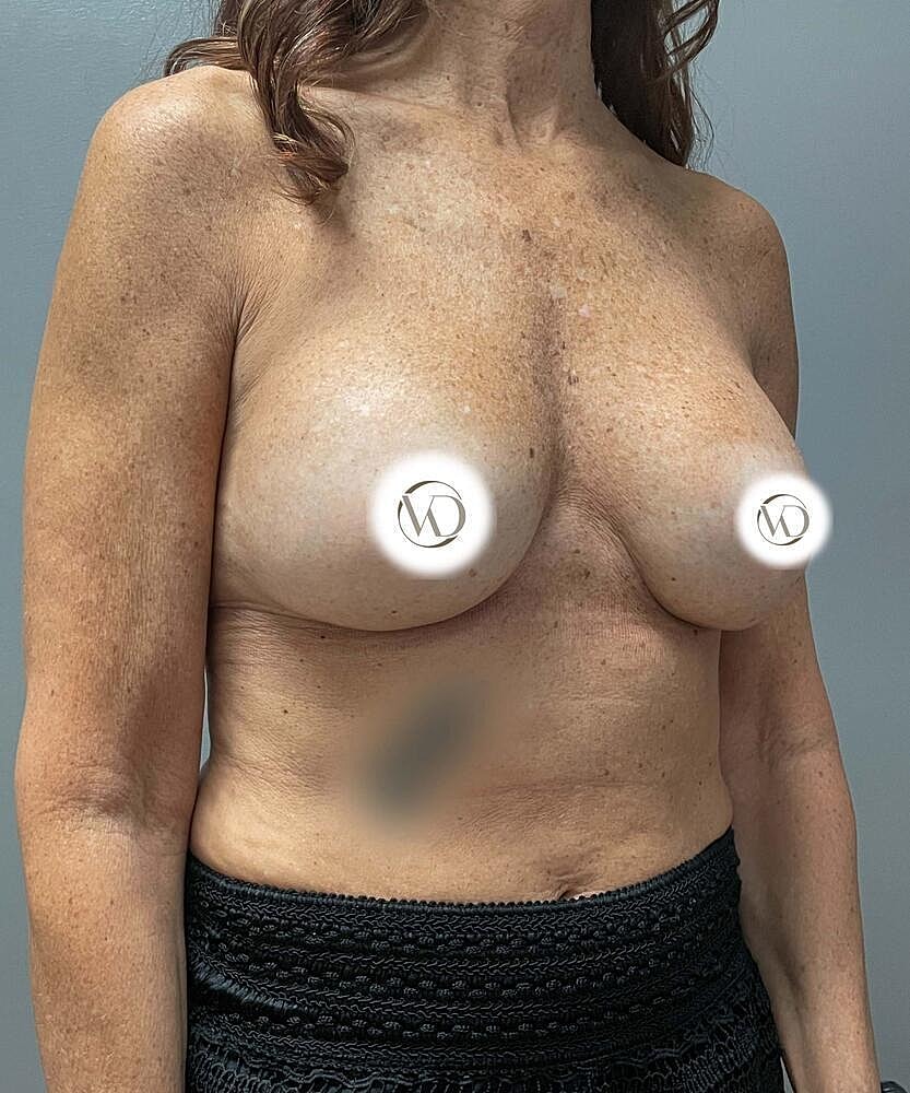 Breast Implant Exchange Before & After