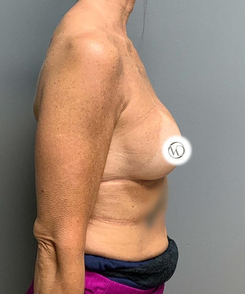 Breast Implant Exchange Before & After