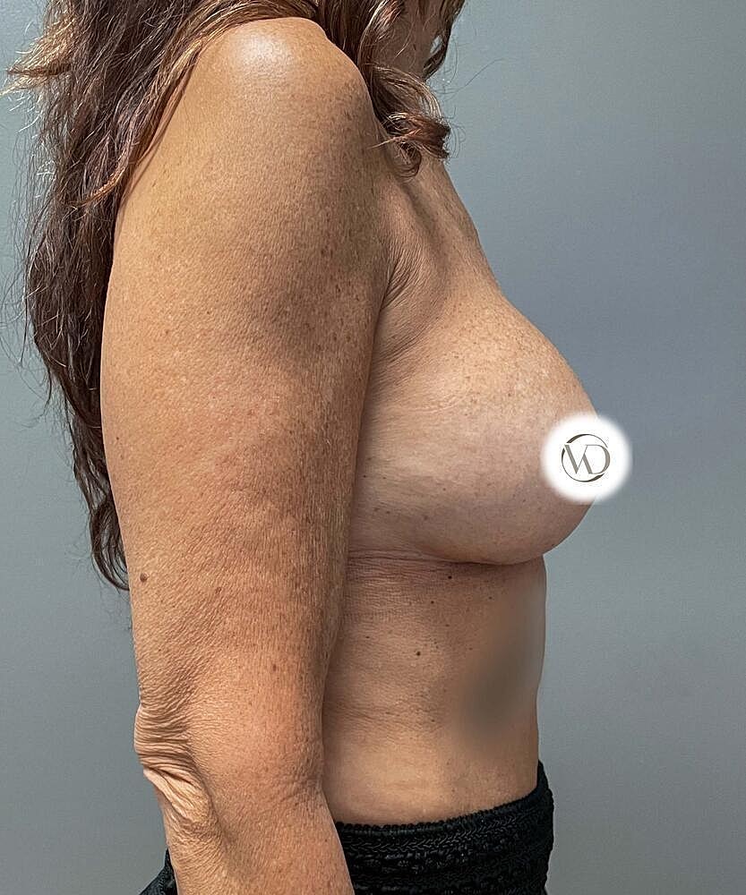 Breast Implant Exchange Before & After