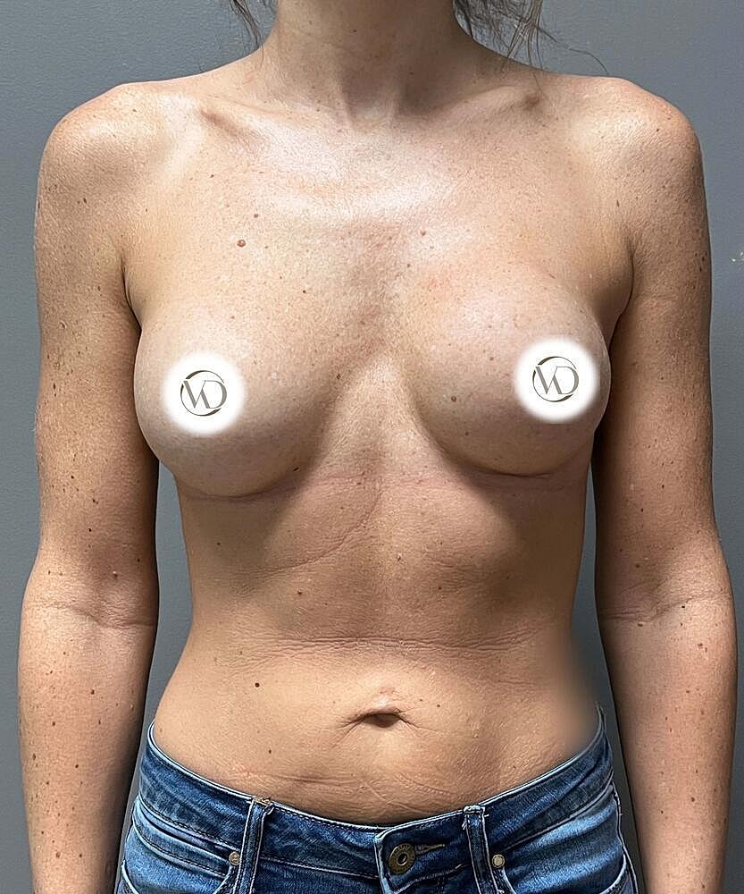 Breast Implant Exchange Before & After