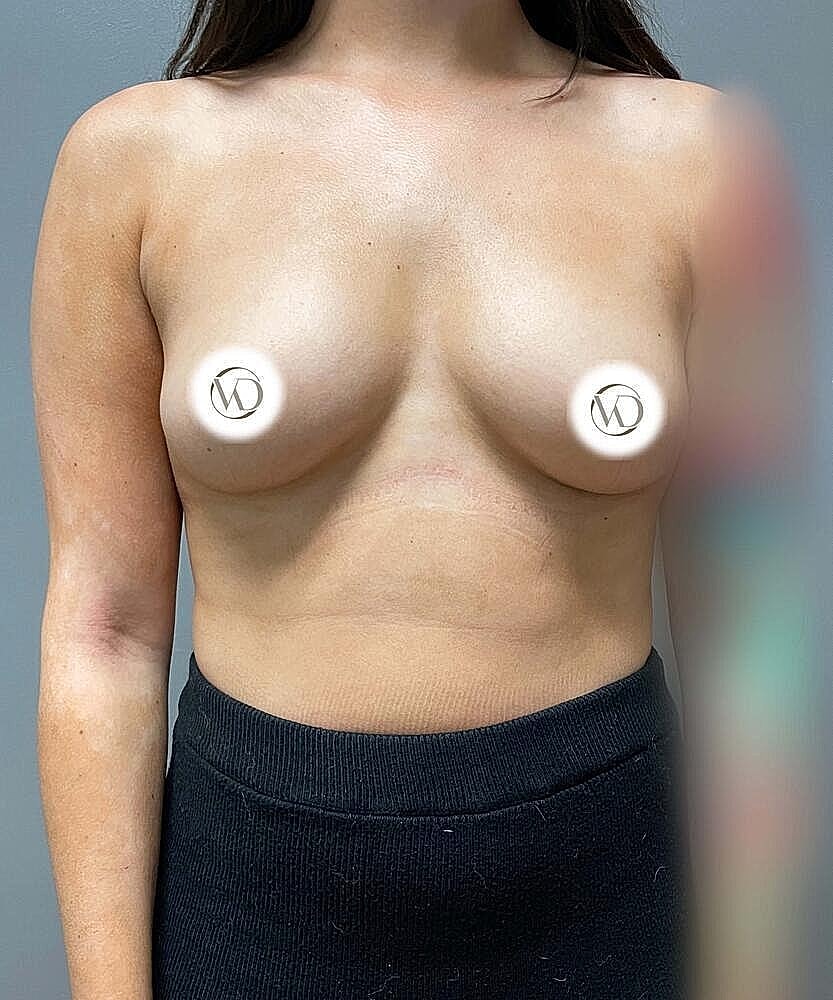 Breast Implant Exchange Gallery Before & After