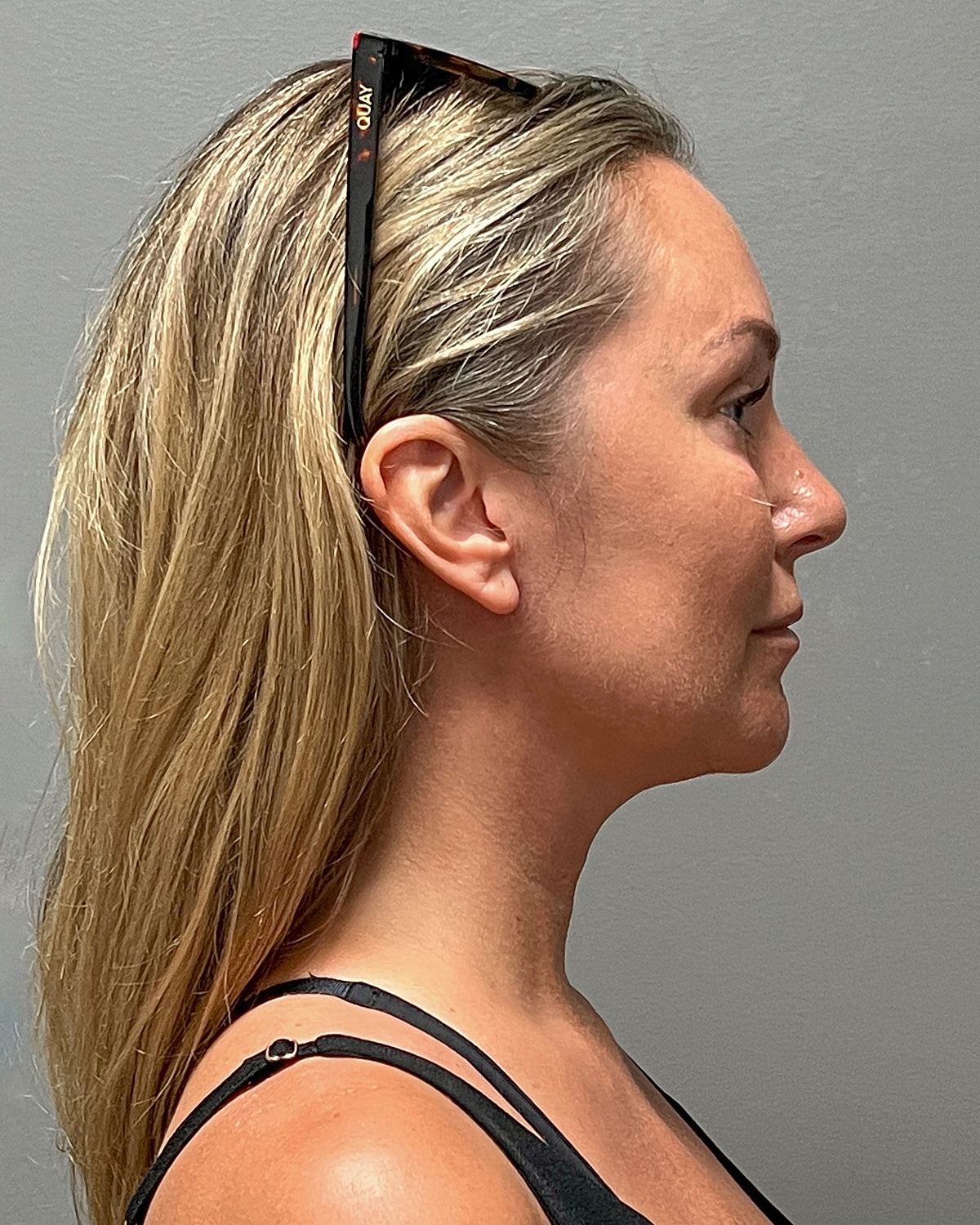 Neck Lift Gallery Before & After