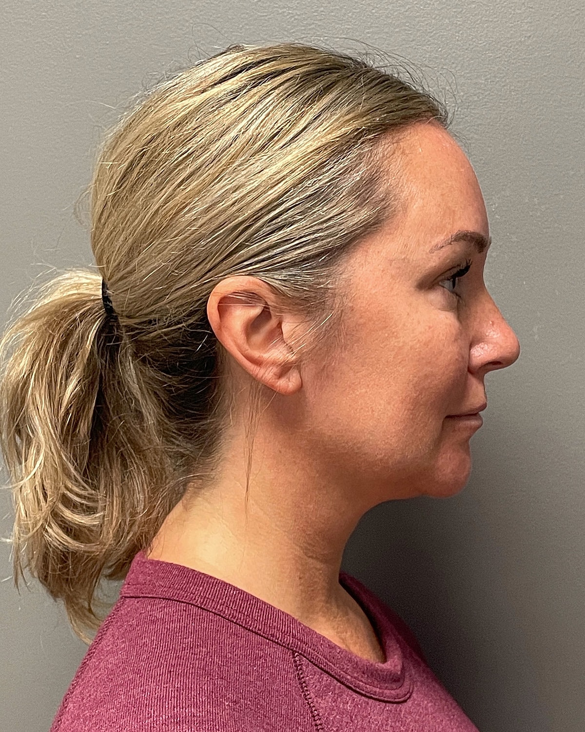 Neck Lift Gallery Before & After