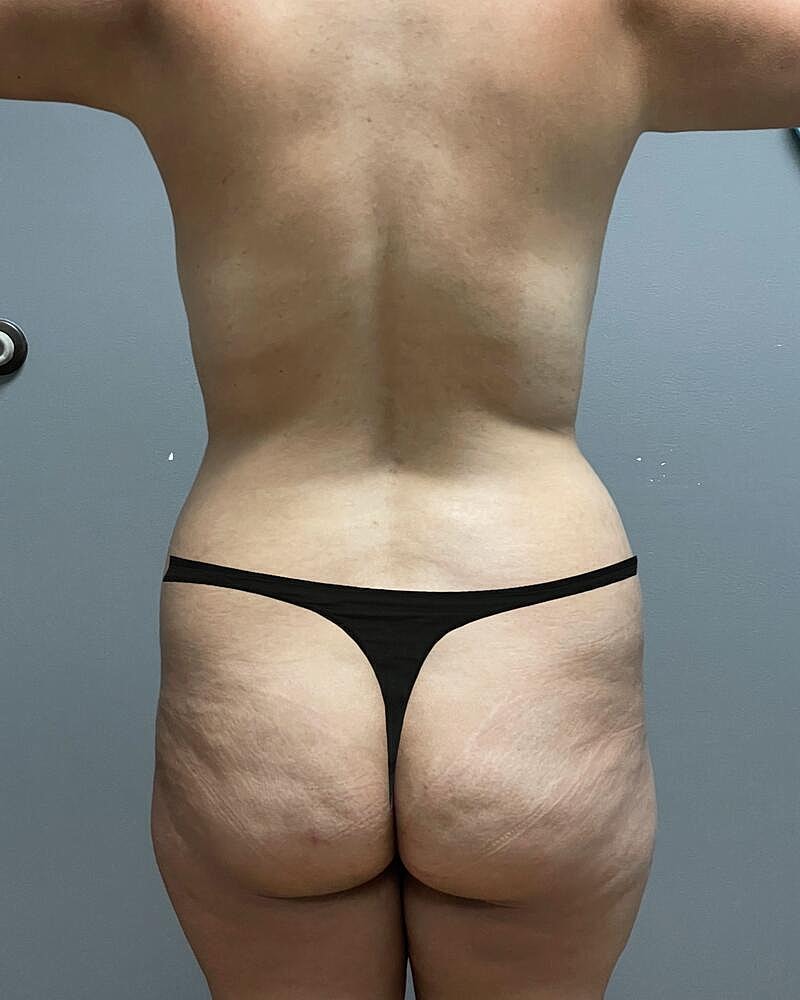 Brazilian Butt Lift Before & After